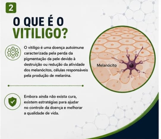O que é o vitiligo: doença autoimune com perda de pigmentação por redução da atividade dos melanócitos.