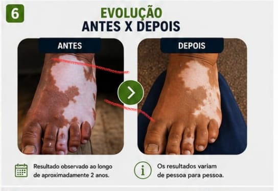 Evolução antes e depois: repigmentação observada ao longo de aproximadamente 2 anos — os resultados variam de pessoa para pessoa.